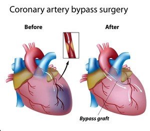 heart-bypass-surgery-260nw-89144566.jpg