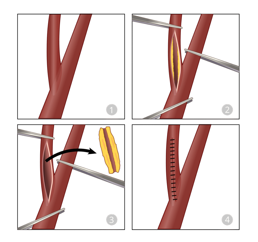 Carotid Endarterectomy svg hariadhi