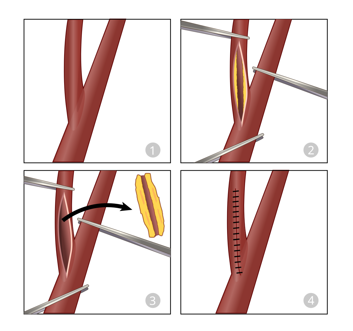 Carotid Endarterectomy svg hariadhi