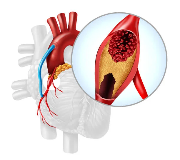 Coronary Endarterectomy