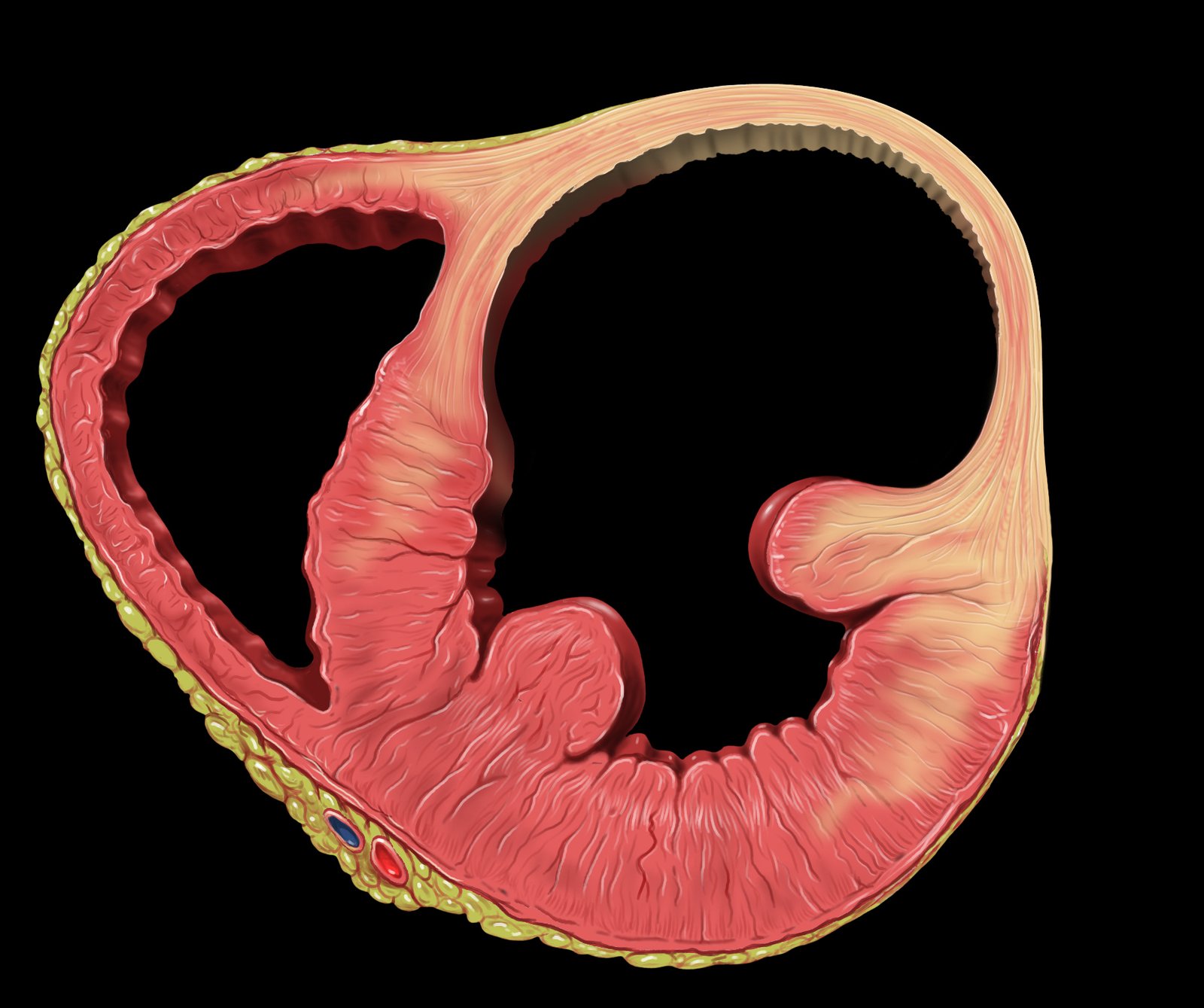 Heart left ventricular aneurysm