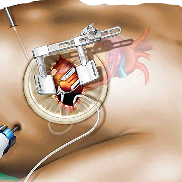 MICS-CABG