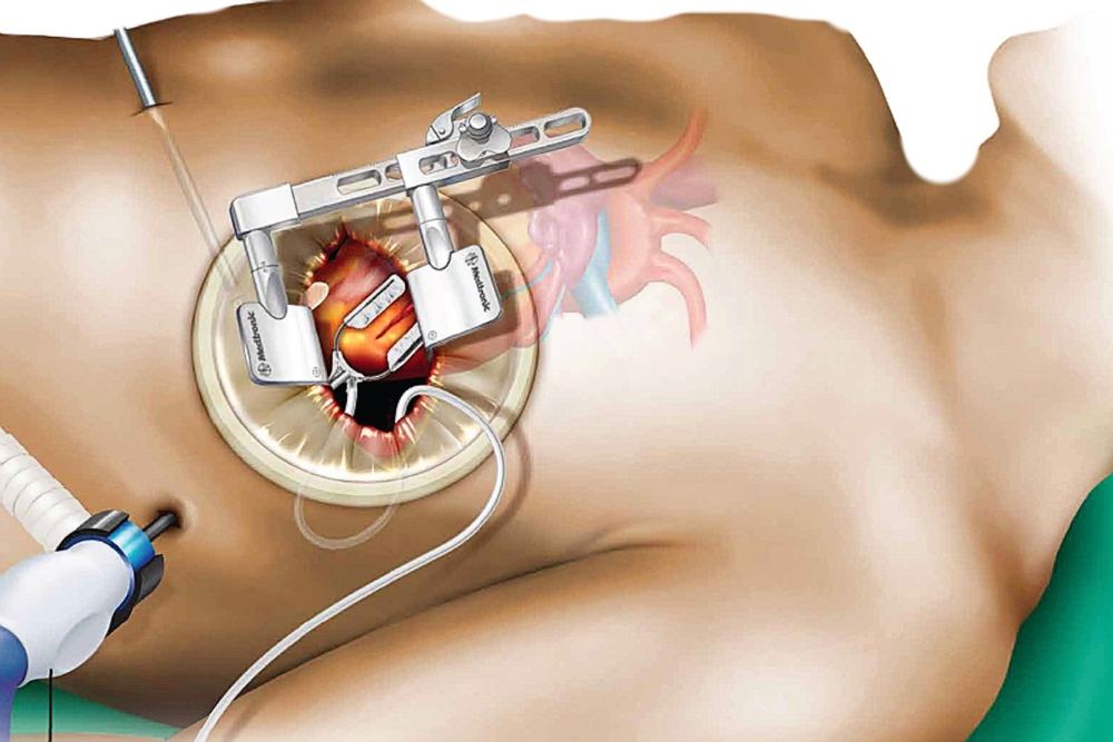 Minimally Invasive CABG