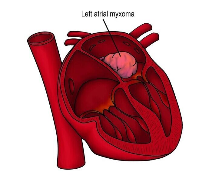Left atrial myxoma