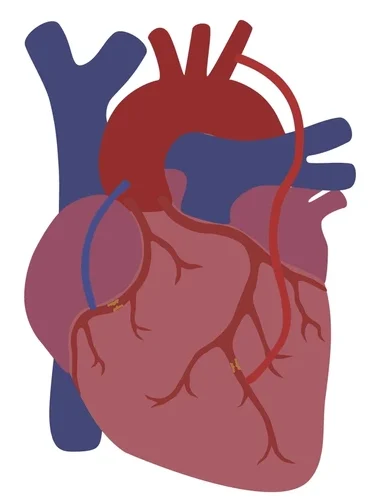 Minimally Invasive CABG