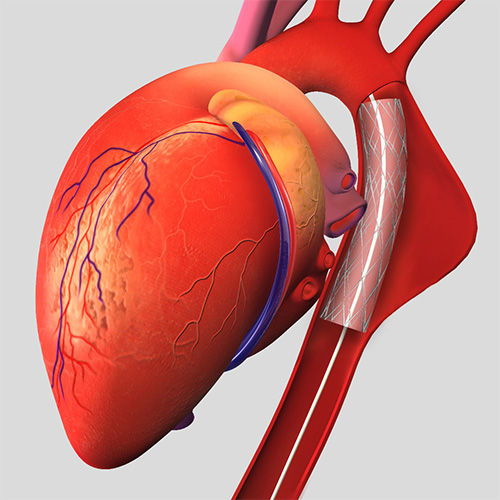 Aneurysm Repair Surgery