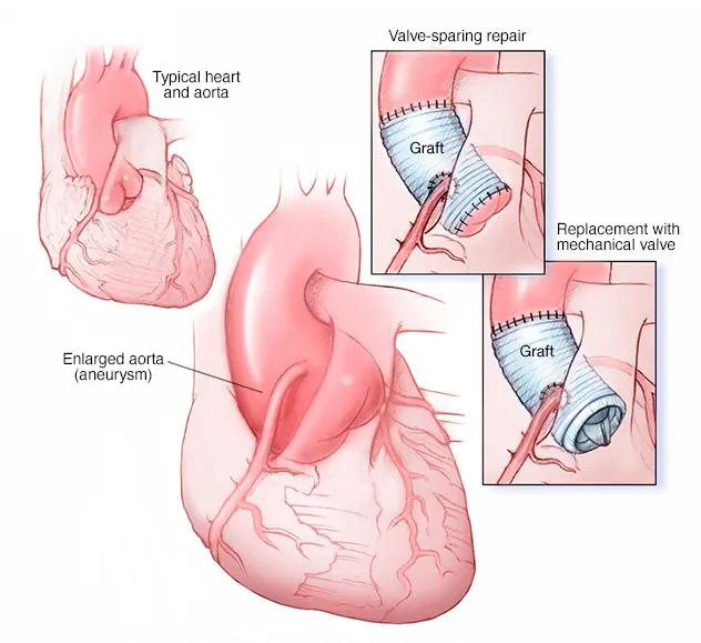 Aortic Root Replacement Surgery