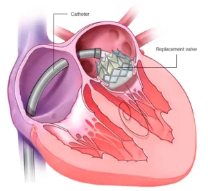 Transcatheter Mitral Valve Repair