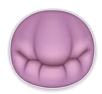 Mitral Valve Replacement