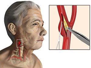 Carotid Artery Surgery