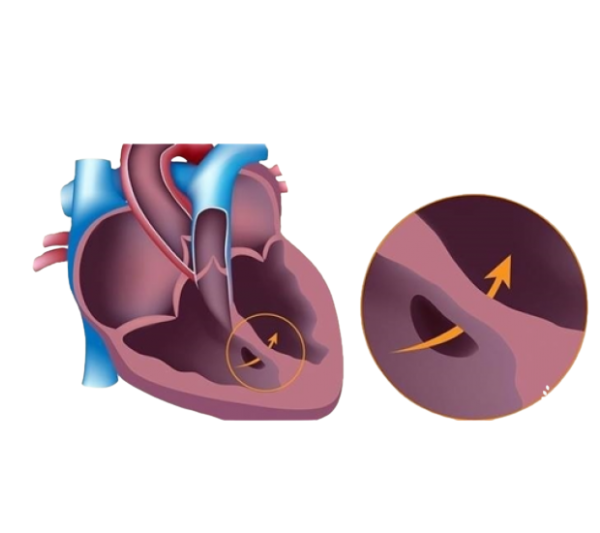 Repair of Congenital Heart Defects