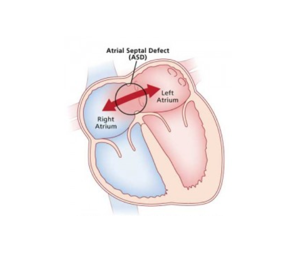 Untitled design (34) ASD / VSD Closure Surgery