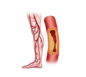Venous Surgeries