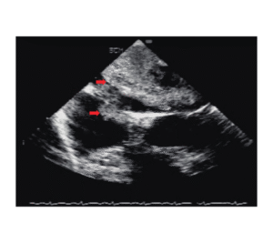 Biatrial Myxoma