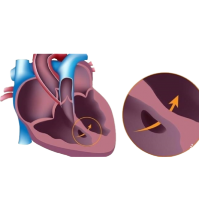Repair of Congenital Heart Defects