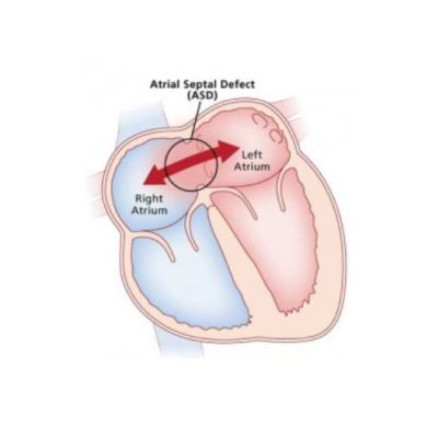 ASD / VSD Closure Surgery