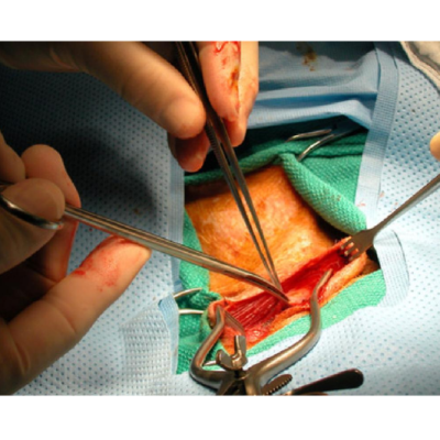 Arterial Surgeries