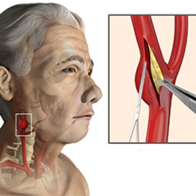 Carotid Artery Surgery