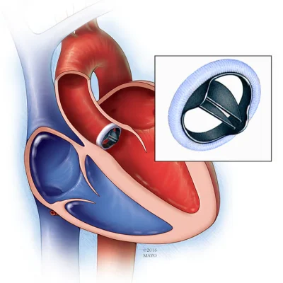 Heart Valve Surgery