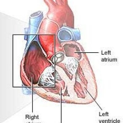 right Right Atrial Myxoma